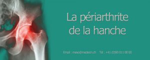 Mésothérapie et périarthrite de la hanche